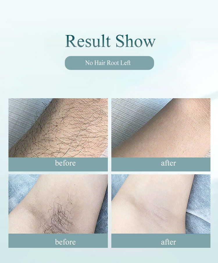 Laser Hair Removal Equipment