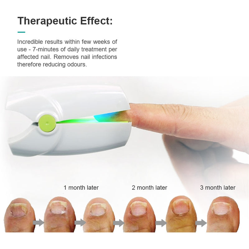 Nail Fungus Laser Nail Treatments Device