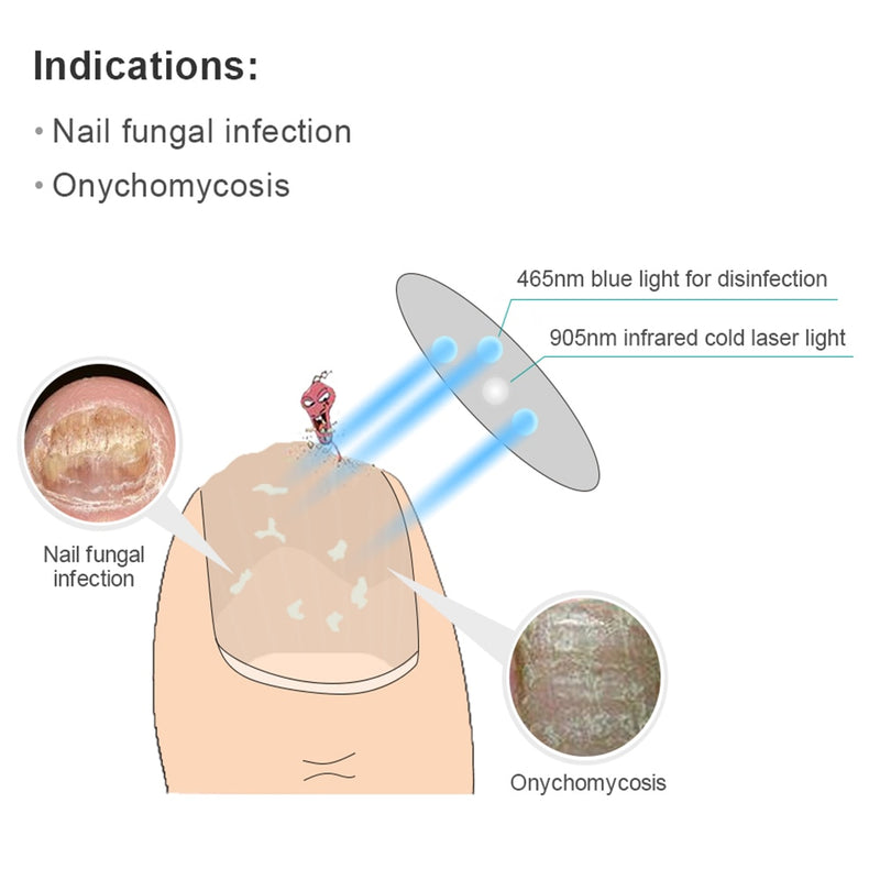 Nail Fungus Laser Nail Treatments Device
